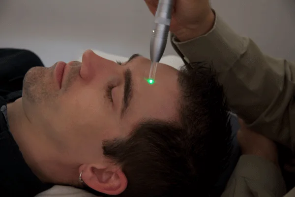 Colorpuncture being done on the face