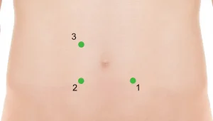 Aggressive Zone therapy - Colorpuncture