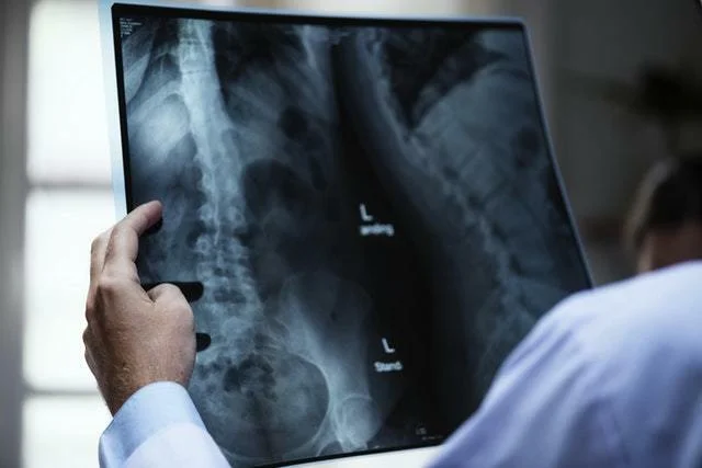 Stress, Posture, and Back Pain, Are they Linked? Person holding an X-Ray